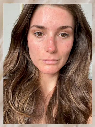 A selfie of Eleanor the following day after her RF microneedling treatment