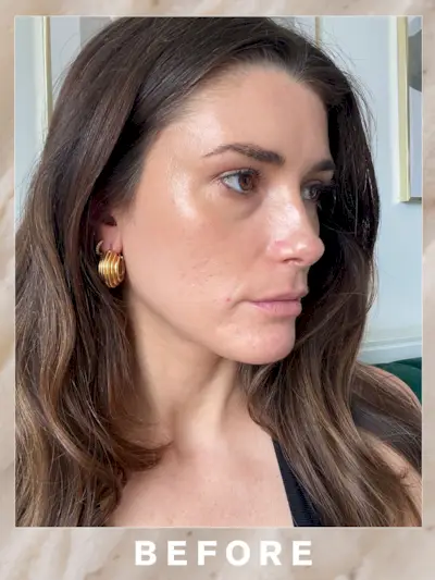 Eleanor's skin before RF microneedling