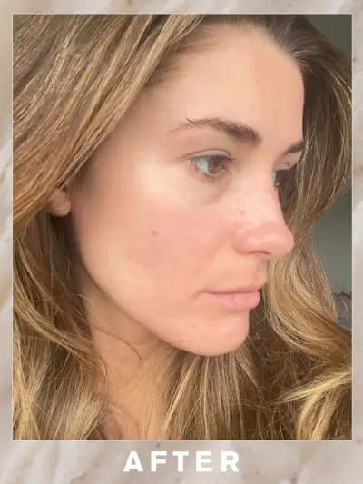 Eleanor's skin after RF microneedling