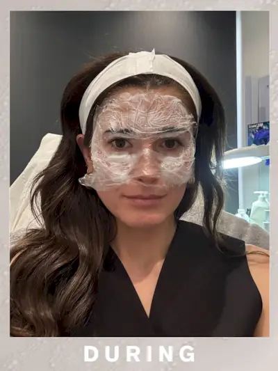 Eleanor wearing numbing cream prior to her Sofwave treatment