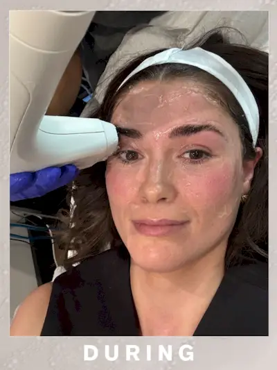 Eleanor during the Sofwave treatment, with the device on her eyebrows