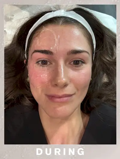 One side of the face treated with Sofwave vs the untreated side