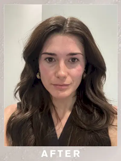 Immediately after the Sofwave treatment