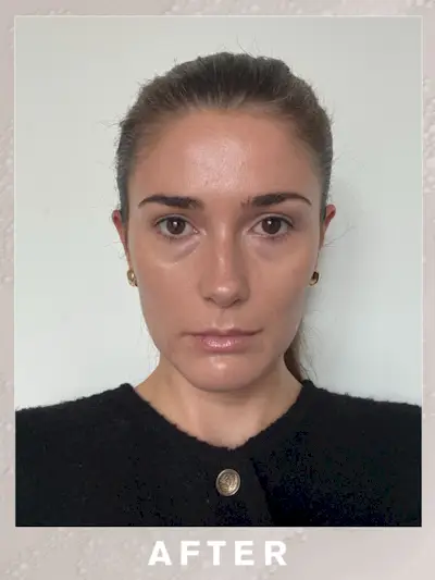 A selfie of Eleanor three months after her Sofwave brow lift treatment