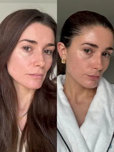 Before and after using Shark CryoGlow LED Mask after one month