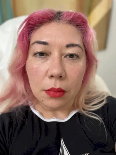 10 days after Skinvive