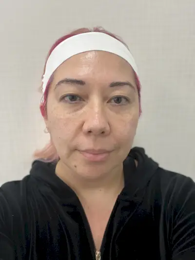 Before getting skinvive